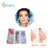 Skinject 2ml Deep Safe Ha Dermal Filler for Facial Injection