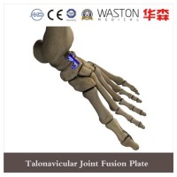 Talonavicular Joint Fusion Locking Plate