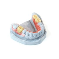 Mer Dental Lab Removable Restoration Partial Valplast Denture