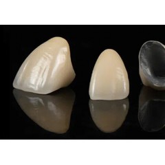 PFM Implant Crown Bridge图3